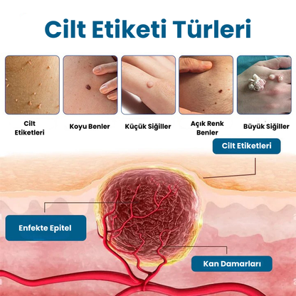 Timilk® DermaVenom RX+ Siğil, Et Beni ve Cilt Çıkıntısı Giderici Krem